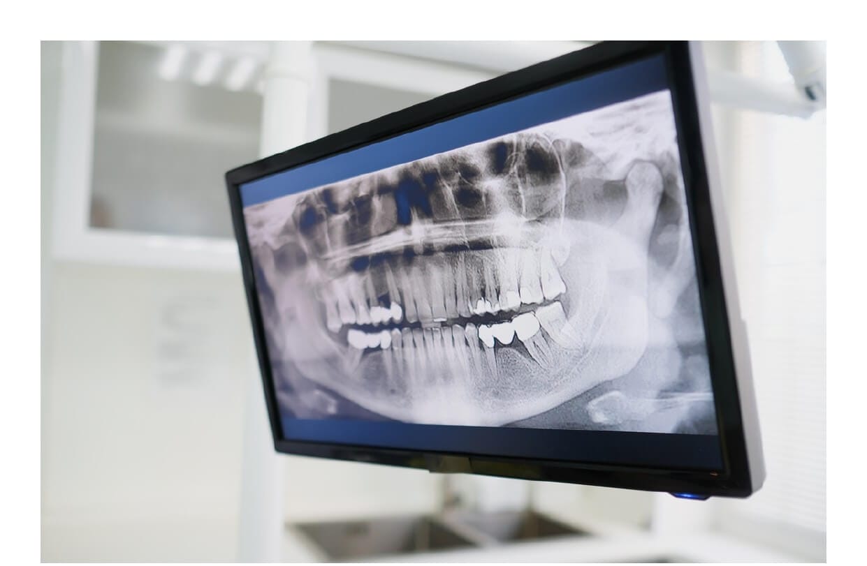 kartal implant